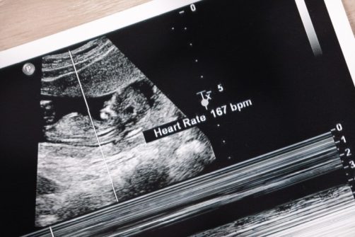 Fetal Heartbeat Bill Close to Becoming Law in Texas