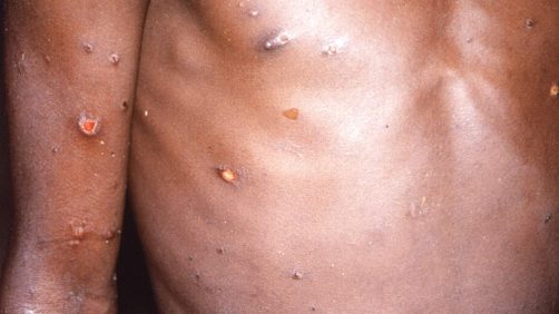 Monkeypox Scare: Biden Admin Orders 13 Million Doses of New Vaccine