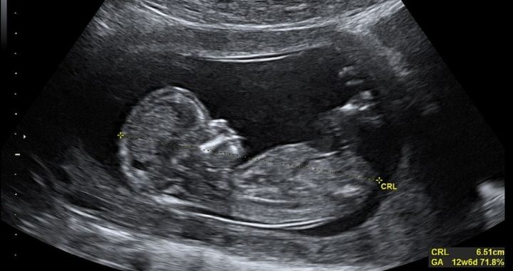 Pre-Born Baby’s Smile During Ultrasound Prompts Mother to Reject Abortion