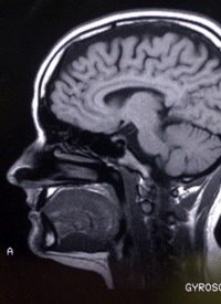 A Breakthrough for Schizophrenia? Part I: Speculation Surrounds Babies’ MRIs