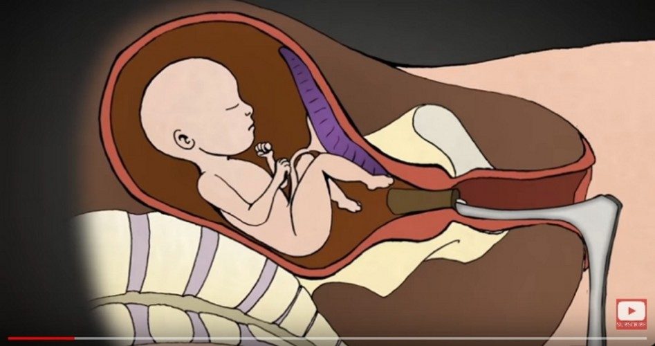 YouTube Removes Pro-life Titles From Top “Abortion” Video Searches