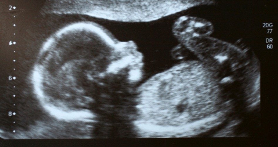 New Zealand Proposes Radical Abortion Law