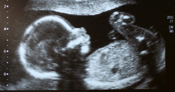 Oklahoma Senate Passes Bill Barring Abortions if Brainwaves, Heartbeat Detected