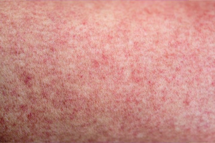 Scarlet Fever: A Disease From the Past Claws Its Way to the Present