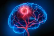 Curing Incurable Brain Tumors